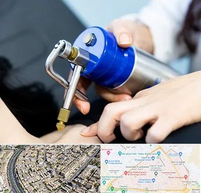 کرایوتراپی در شهرک غرب مشهد