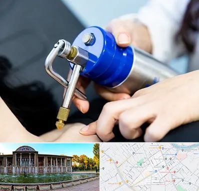 کرایوتراپی در عفیف آباد شیراز