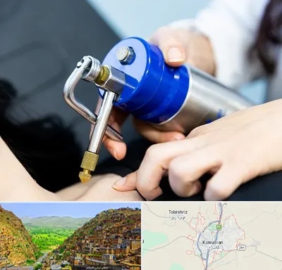 کرایوتراپی در کامیاران