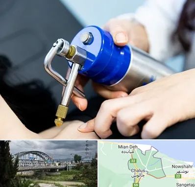 کرایوتراپی در چالوس