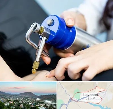 کرایوتراپی در لواسان