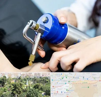 کرایوتراپی در منطقه 13 تهران 