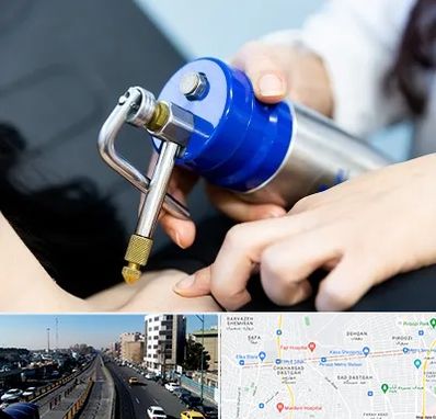 کرایوتراپی در پیروزی 