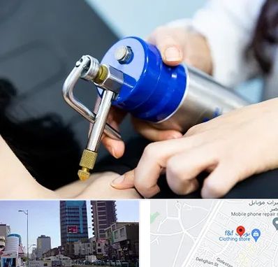 کرایوتراپی در چهارراه طالقانی کرج