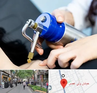 کرایوتراپی در ولیعصر شهریار