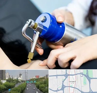 کرایوتراپی در توانیر