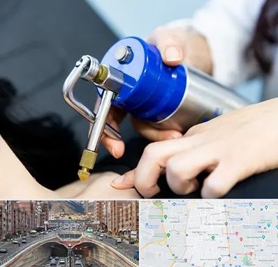 کرایوتراپی در منطقه 10 تهران 