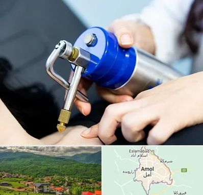 کرایوتراپی در آمل