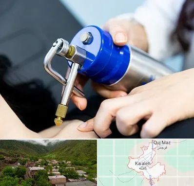 کرایوتراپی در کلاله