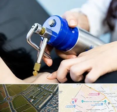 کرایوتراپی در الهیه مشهد