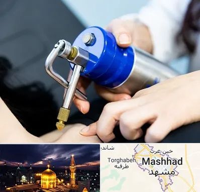 کرایوتراپی در مشهد