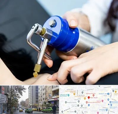 کرایوتراپی در فاطمی 