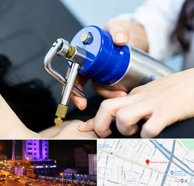 کرایوتراپی در آبرسان تبریز