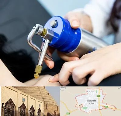 کرایوتراپی در ساوه