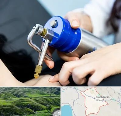 کرایوتراپی در گچساران