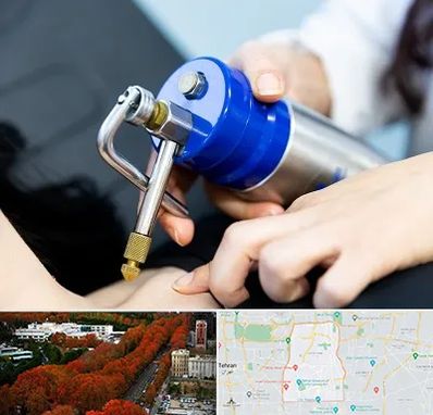 کرایوتراپی در منطقه 6 تهران 