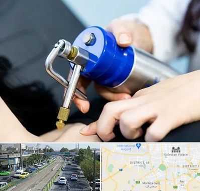 کرایوتراپی در جنوب تهران 