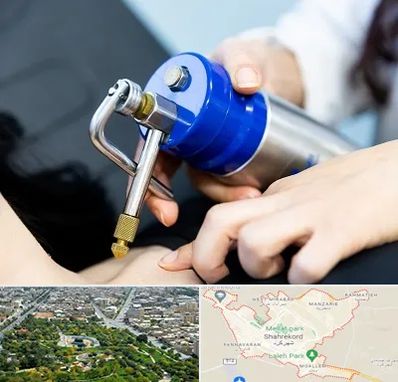 کرایوتراپی در شهرکرد