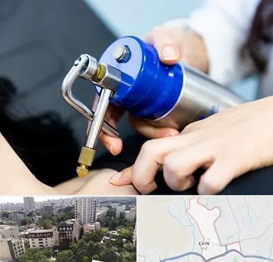 کرایوتراپی در اوین