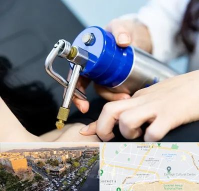 کرایوتراپی در تهرانپارس 