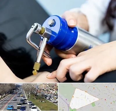 کرایوتراپی در احمدآباد مشهد 