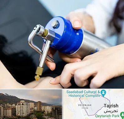 کرایوتراپی در زعفرانیه 