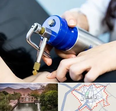 کرایوتراپی در دامغان