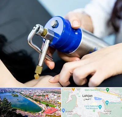 کرایوتراپی در لاهیجان