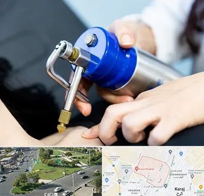 کرایوتراپی در شاهین ویلا کرج