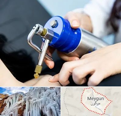 کرایوتراپی در میگون