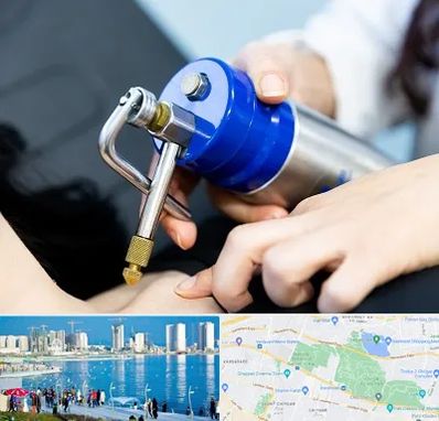 کرایوتراپی در چیتگر 