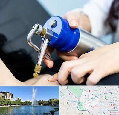 کرایوتراپی در کوهسنگی مشهد