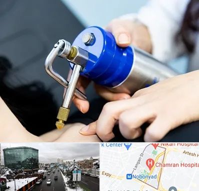 کرایوتراپی در اقدسیه 