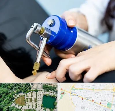 کرایوتراپی در وکیل آباد مشهد 