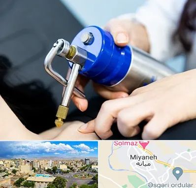 کرایوتراپی در میانه