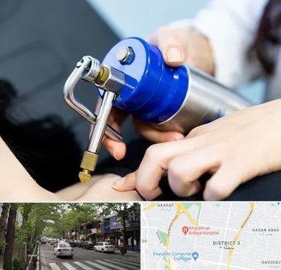 کرایوتراپی در ظفر 