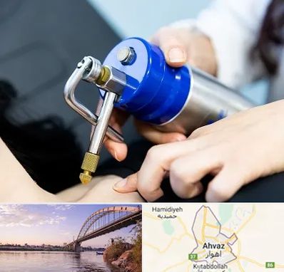 کرایوتراپی در اهواز