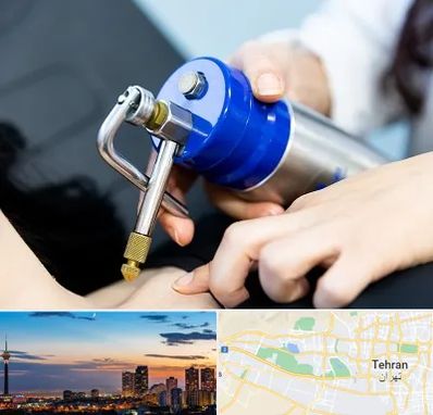 کرایوتراپی در غرب تهران 