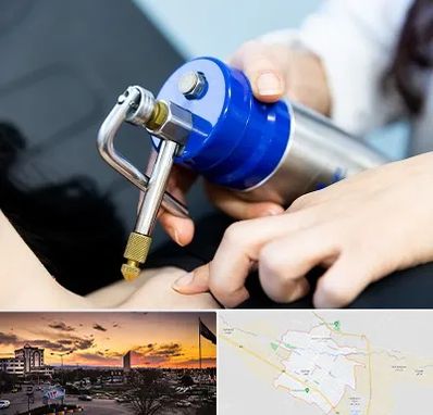 کرایوتراپی در قوچان