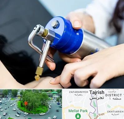 کرایوتراپی در تجریش 