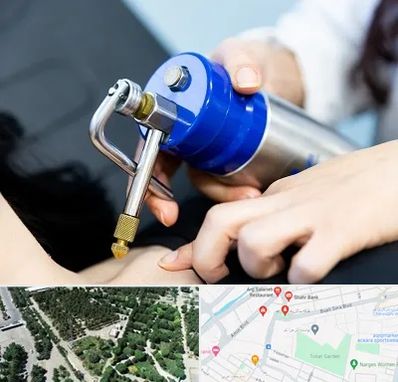 کرایوتراپی در سالاریه قم