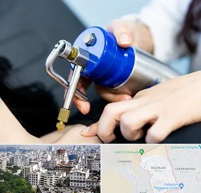 کرایوتراپی در ولنجک 