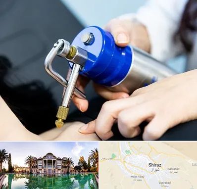 کرایوتراپی در شیراز