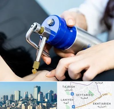 کرایوتراپی در قیطریه 