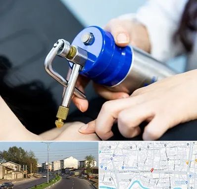 کرایوتراپی در ضیابری رشت