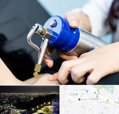 کرایوتراپی در هفت تیر مشهد 