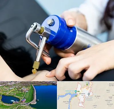 کرایوتراپی در مهاباد