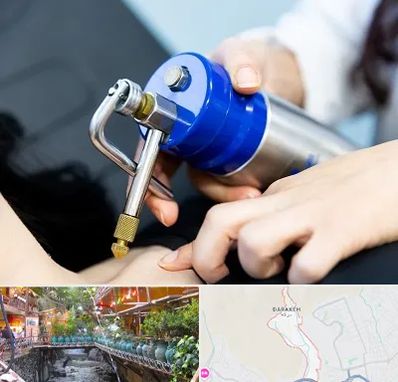 کرایوتراپی در درکه