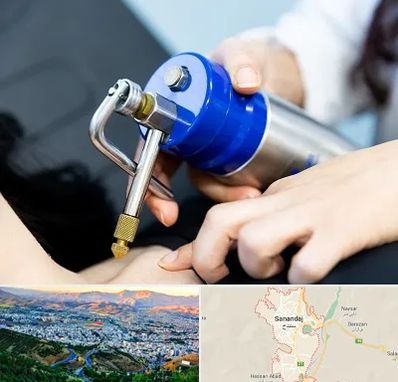 کرایوتراپی در سنندج