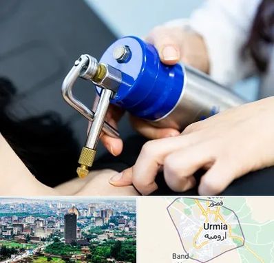 کرایوتراپی در ارومیه